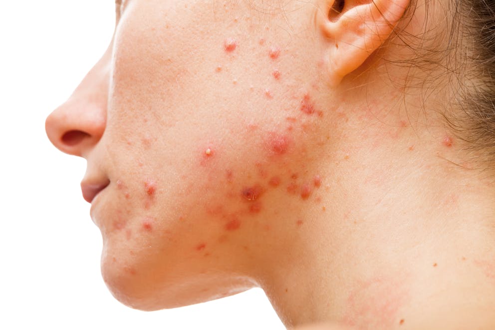 Fungal Acne: What Is Fungal Acne and How Do I Treat It? - How to