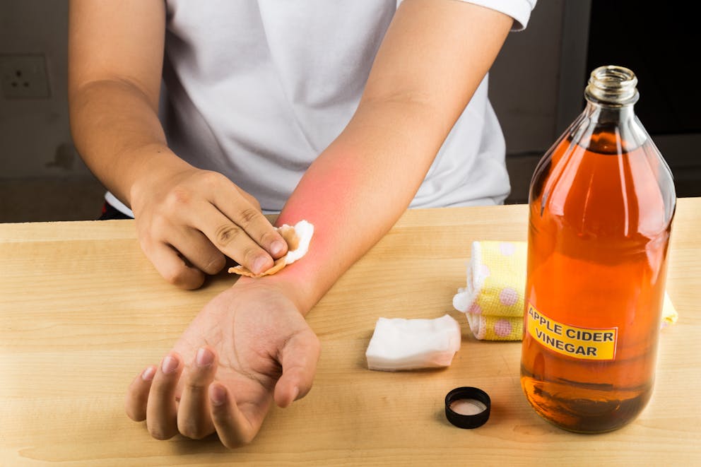 Apple cider vinegar is an effective natural remedy for skin itch, fungal infection, warts, bruises and burns