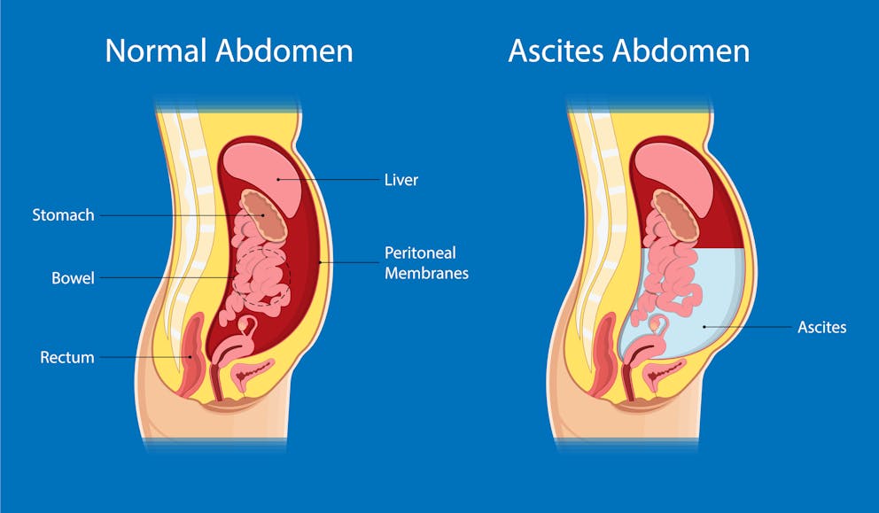 Ascites vs. Belly Fat: Know the Difference