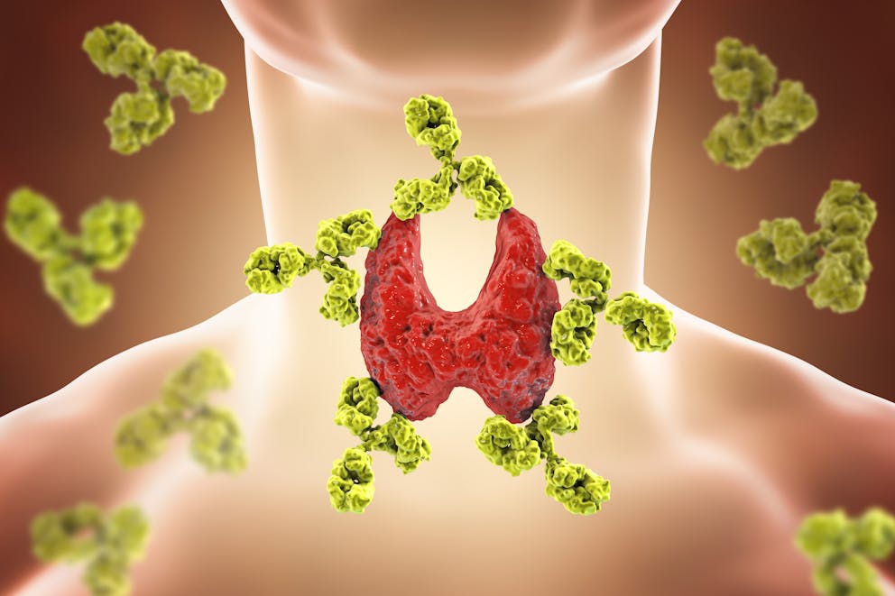 Hashimotos disease concept illustration