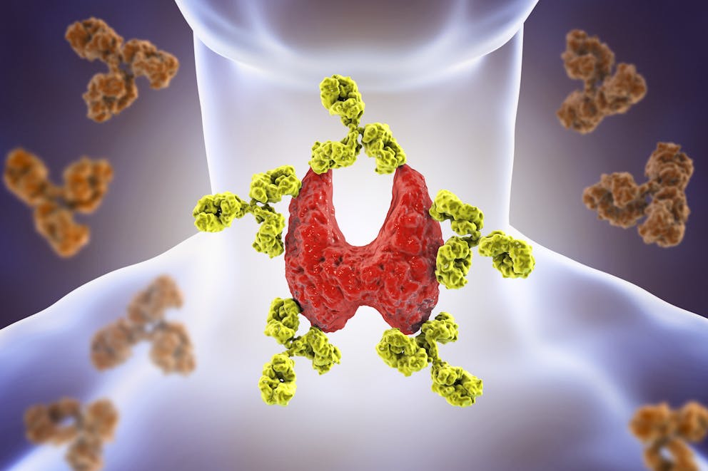 Thyroiditis illustration