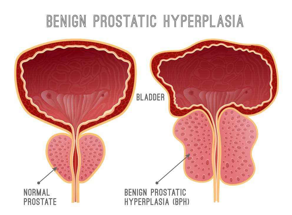 Enlarged prostate gland