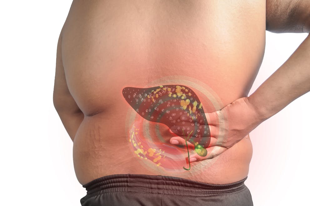Huge Belly but NOT Fat? – Dr.Berg On Cirrhosis & Ascites 
