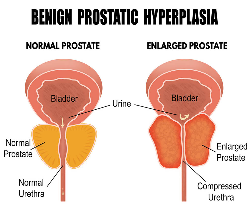 Illustration comparing normal prostate with enlarged prostate and BPH.