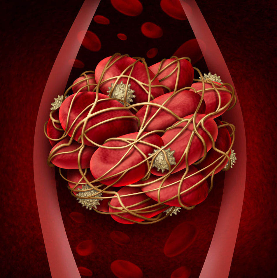 Illustration of platelets, blood clotting, and thrombus in a blood vessel | 7 natural blood thinners