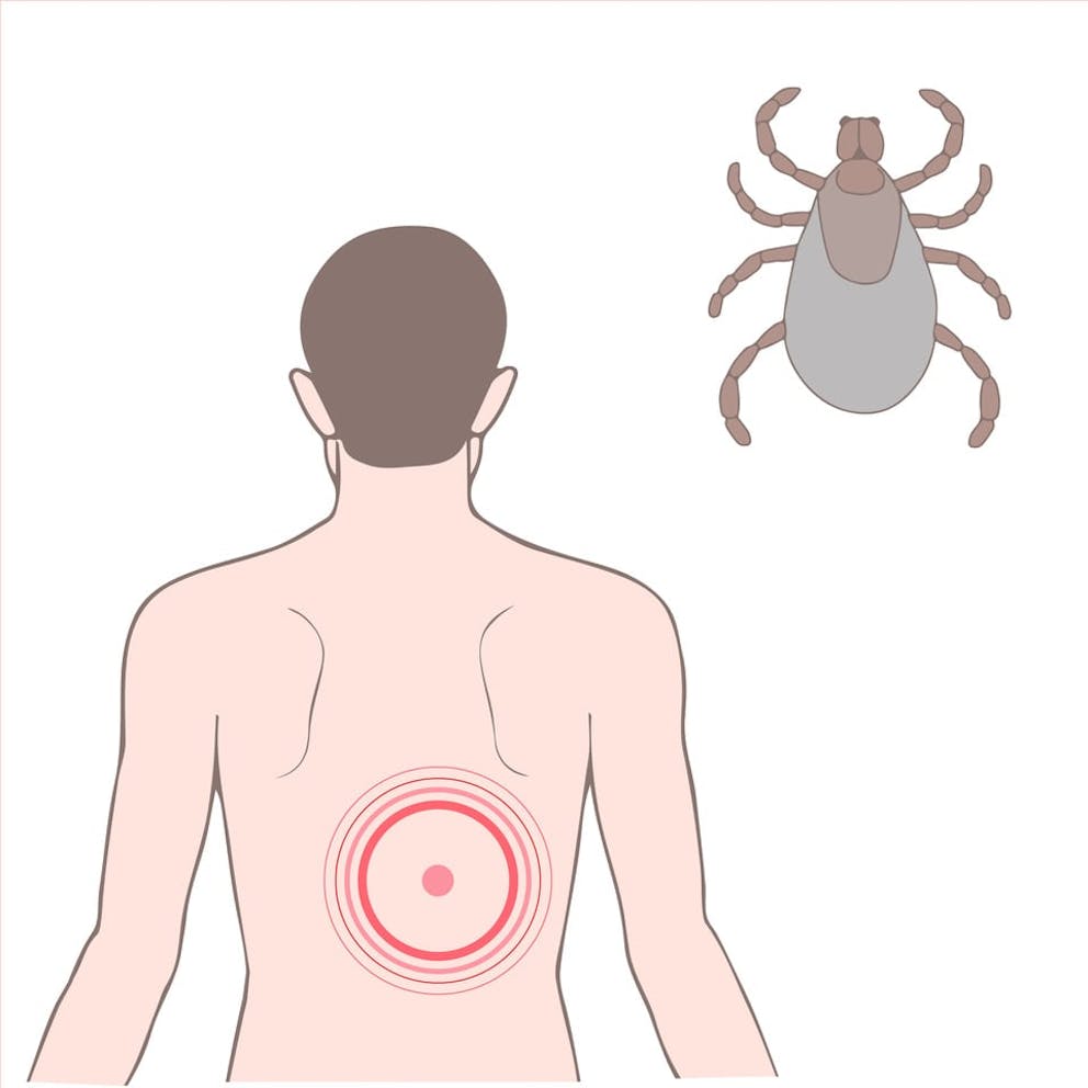 Illustration of man’s back with bullseye rash, drawing of tick, Lyme disease rash on back.