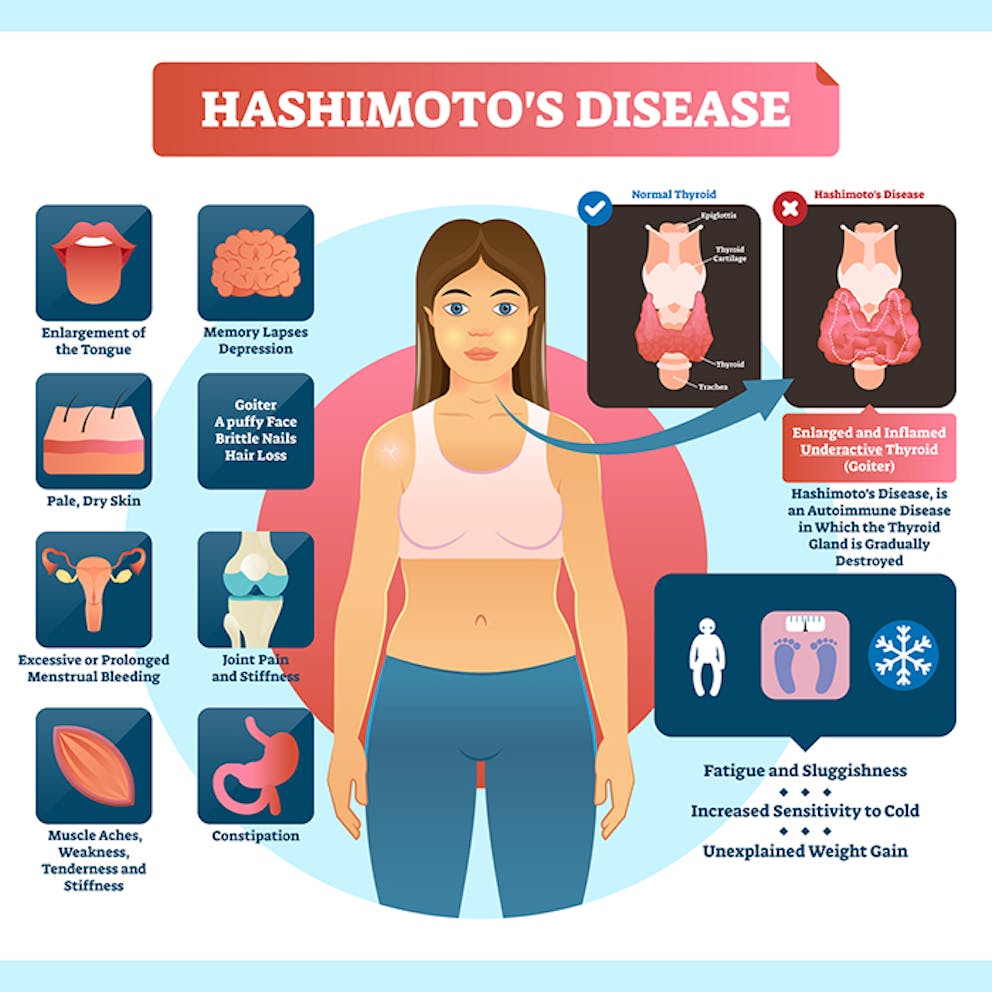 Hashimoto’s hypothyroidism autoimmune disease