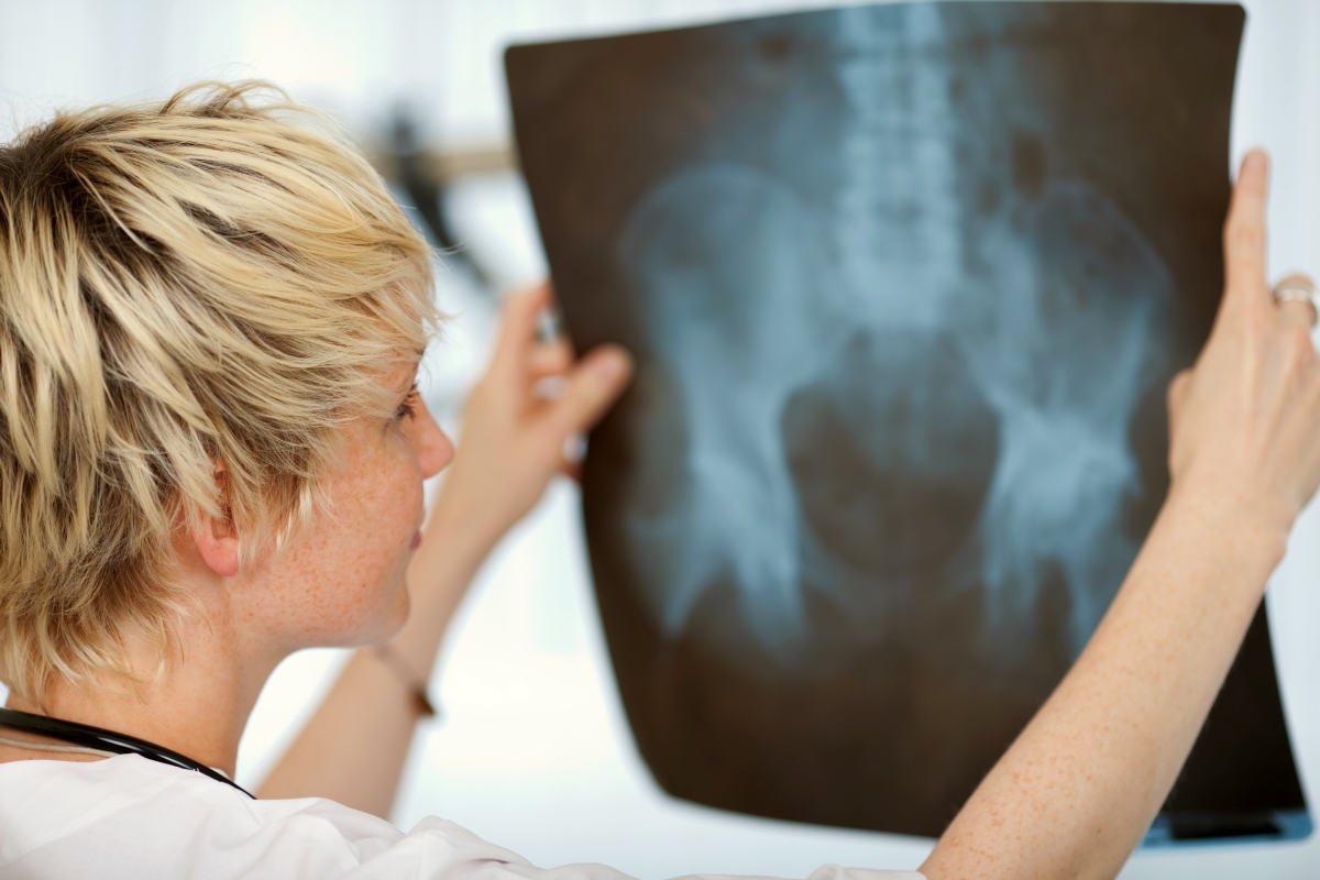 Female doctor looking at hip Xray | The Best Thing To Do If You Have Bone On Bone Knees | Have Bone On Bone Knee | bone on bone knee pain treatments