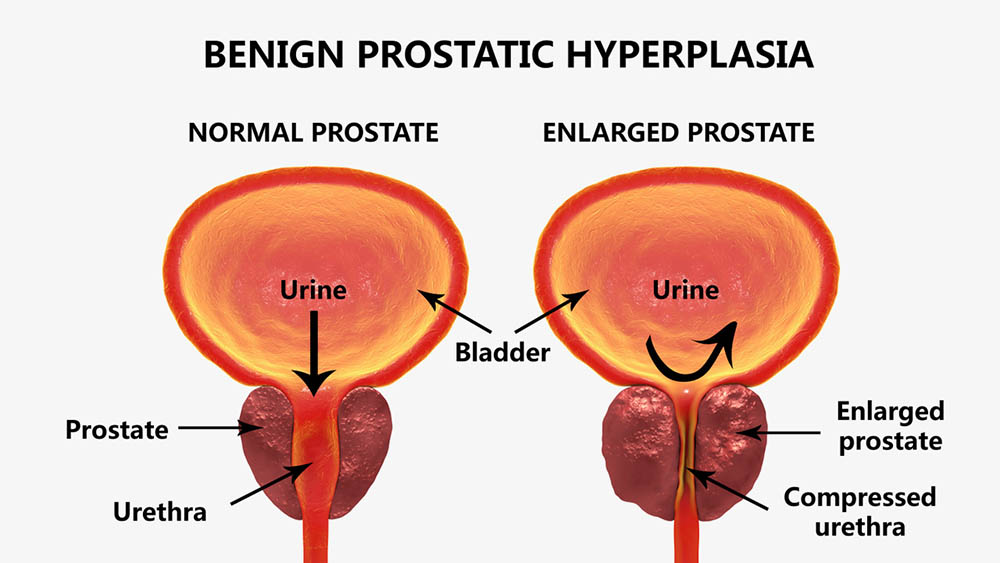 Benign Prostatic Hyperlasia