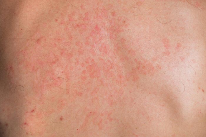 How Do You Get Rid of Tinea Versicolor Permanently?