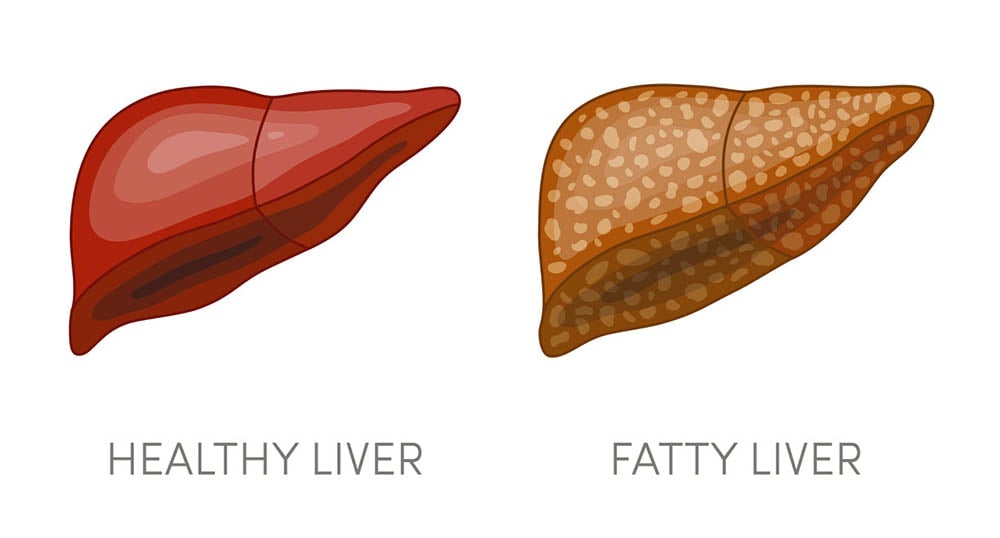 Illustration of a healthy liver and a fatty liver on a white background.