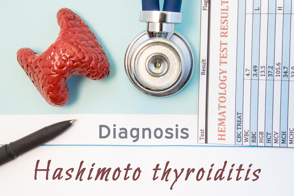 Thyroid gland figure on medical papers with the diagnosis of Hashimoto thyroiditis next to pen and stethoscope