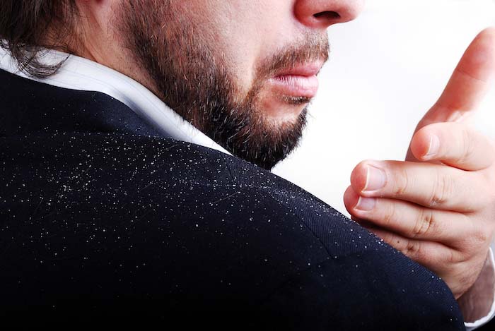 A man wearing a black coat with dandruff on the shoulders. |  Best Remedies for Dandruff