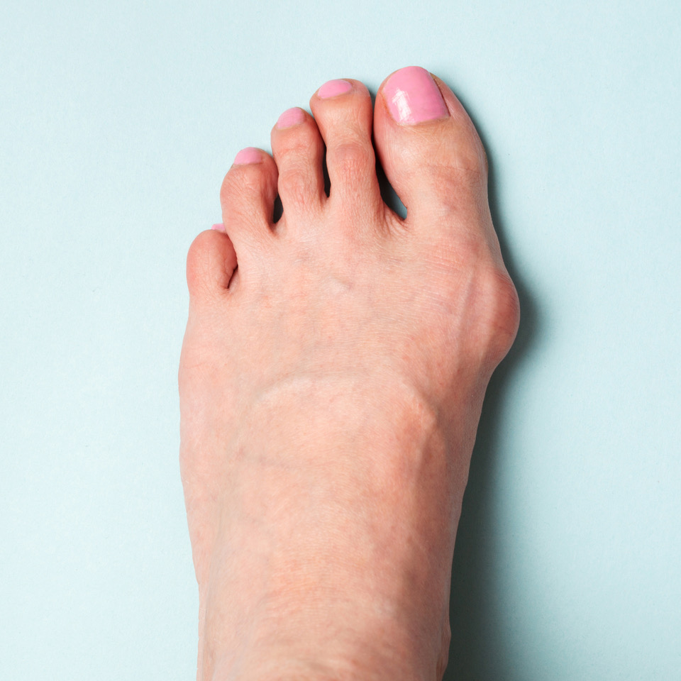A female foot with a bunion on the big toe and pink nail polish on a light blue background.