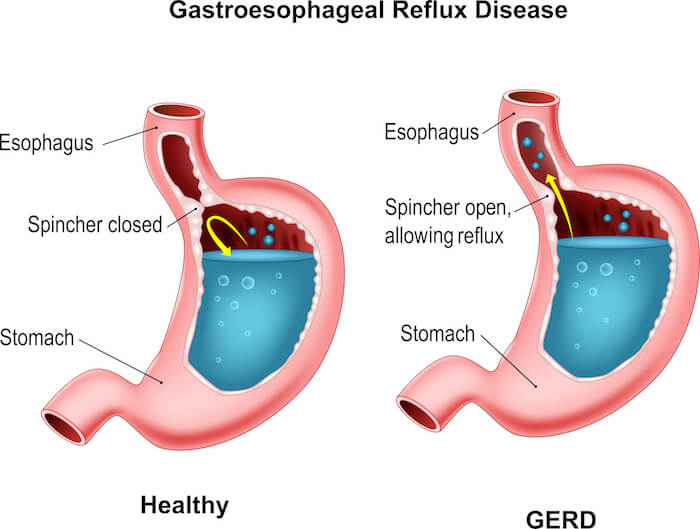 Diagram of the stomach and digestive system |  Bloating, Indigestion, Constipation, and Acid Reflux