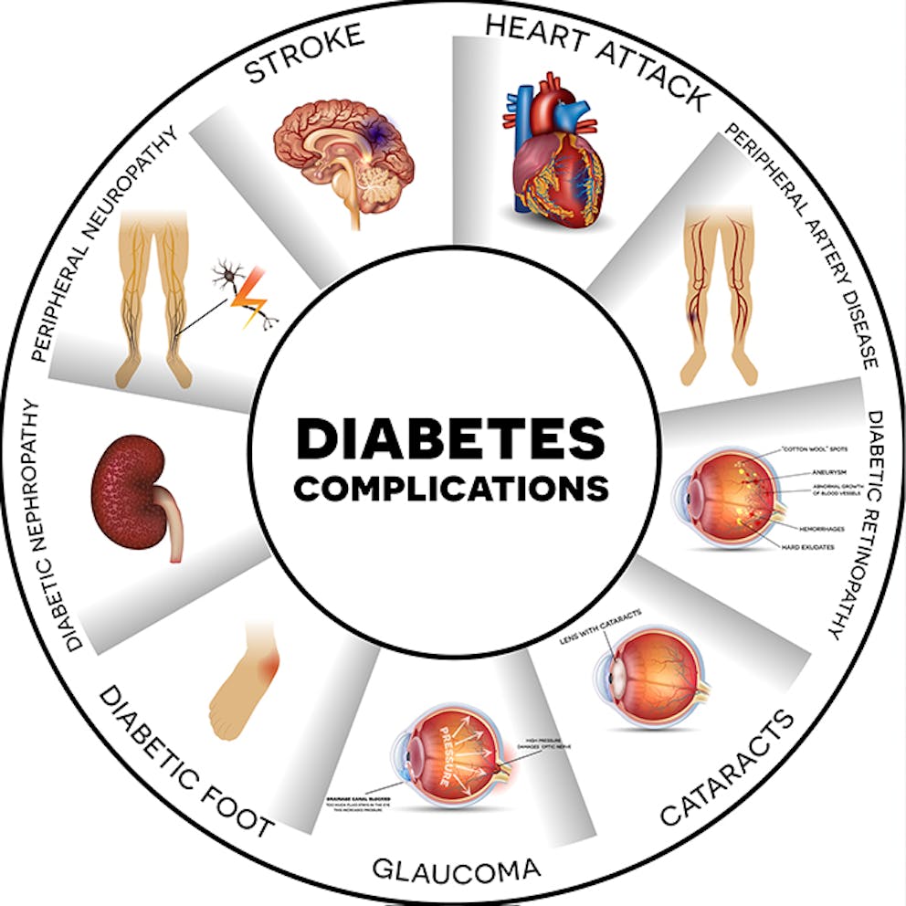 a chart showing the complications of diabetes
