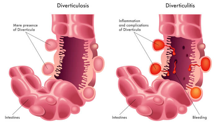 what's the difference between diverticulitis and diverticulosis? | Do I Avoid Seeds and Nuts with Diverticulitis?