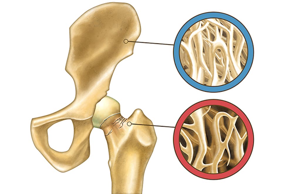 High vegetable intake combats loss of bone 