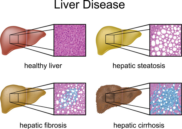 NAFLD and other liver diseases
