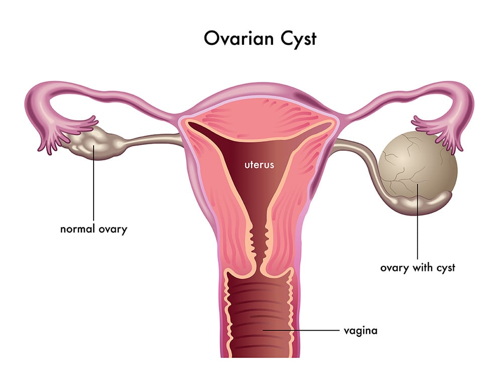 Fix Ovarian Cysts and Fibrocystic Breast with One Mineral