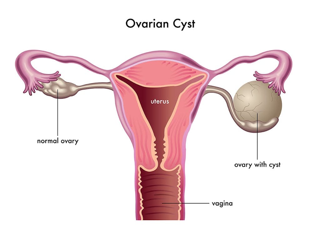 diagram of ovaries with cysts