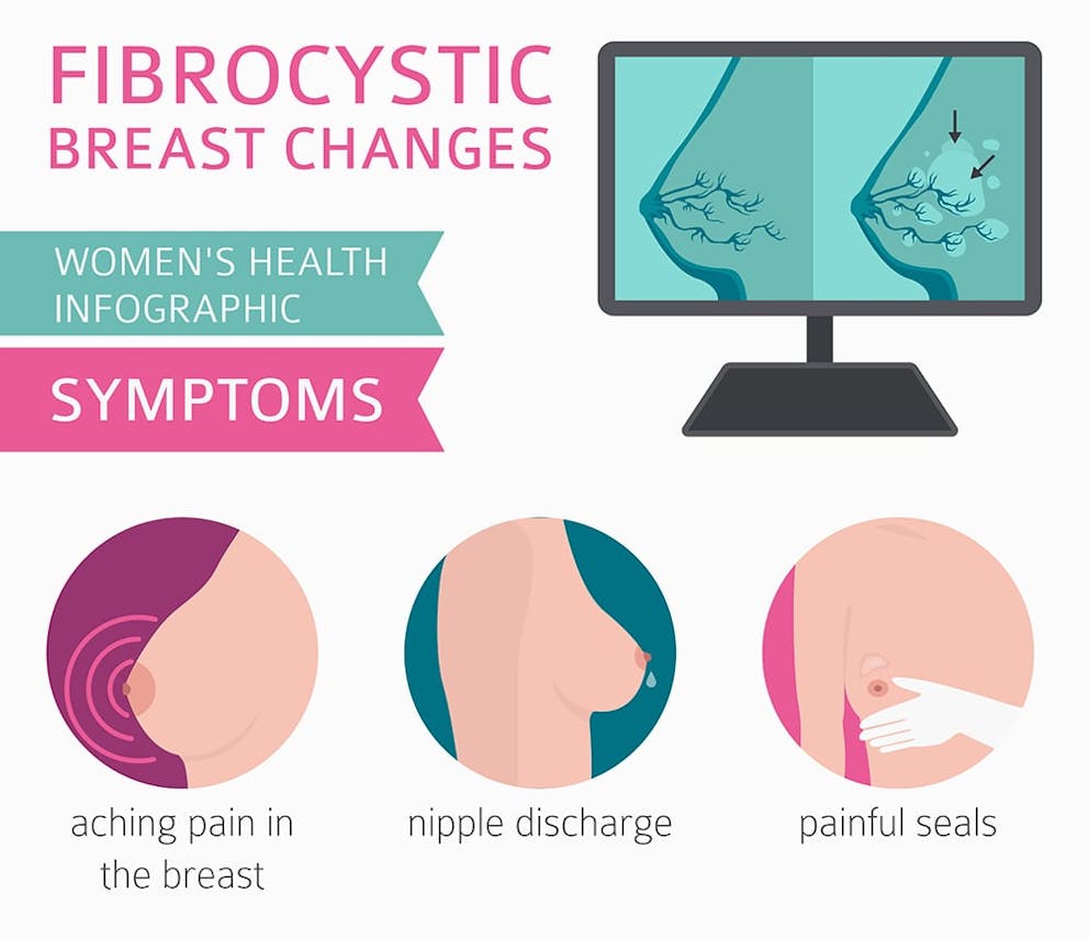 Fibrocystic Breast Disease: Causes, Symptoms, and Diagnosis