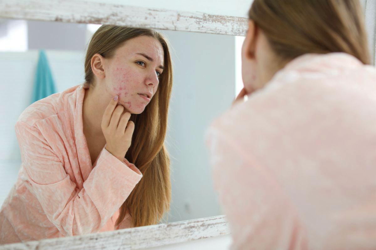 Young woman with acne problem near mirror | How To Get Rid Of Acne Fast