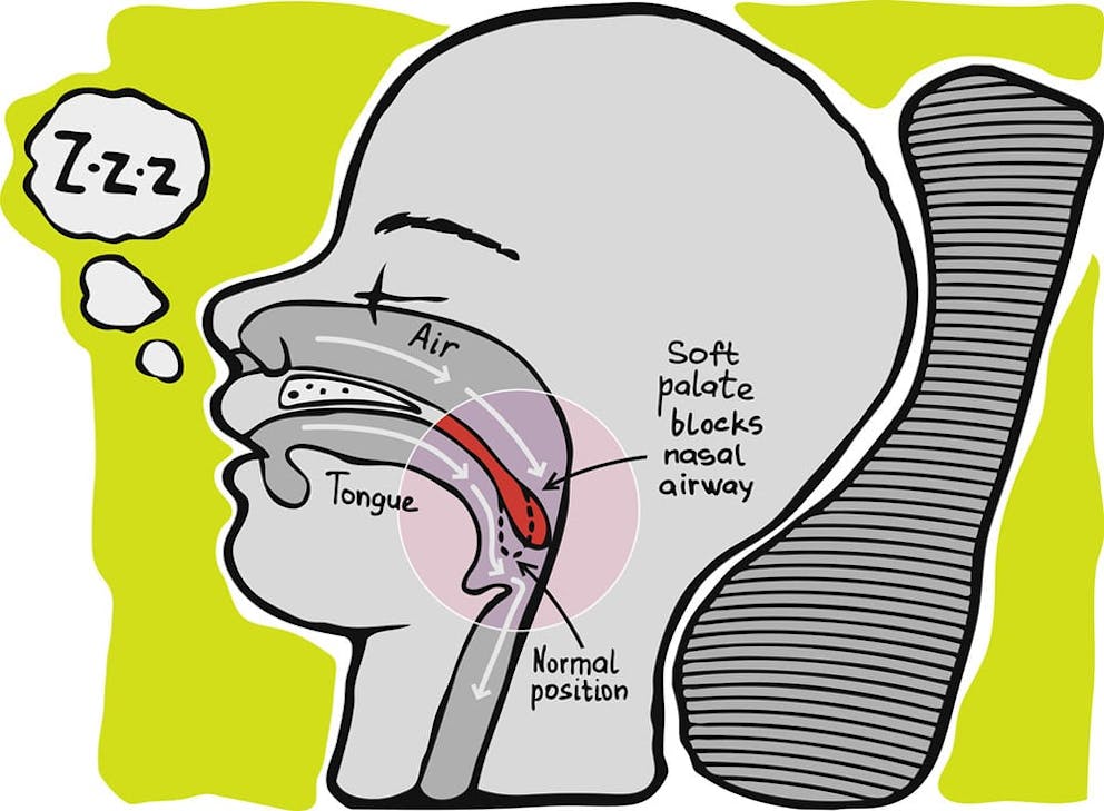 An illustrated diagram of snoring anatomy, soft palate, nasal airway, blocked air, sleep apnea.