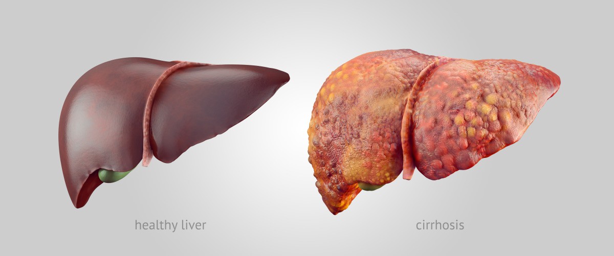 Realistic illustration of comparsion of healthy and sick (cirrhosis) human livers | How To Reverse A Fatty Liver