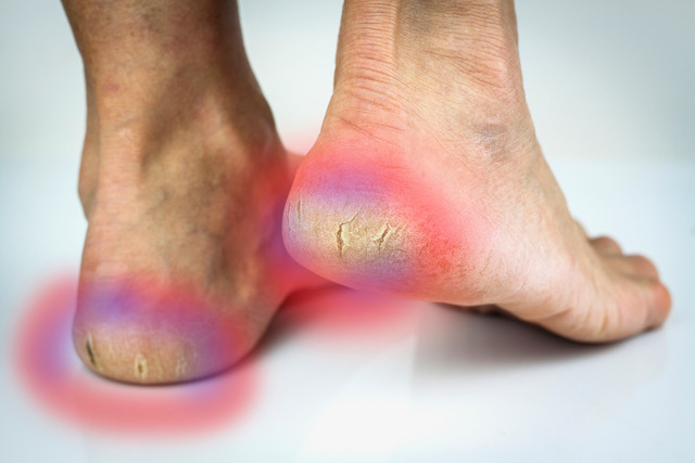 Cracked Heels | What Causes Cracked Heels - NIVEA