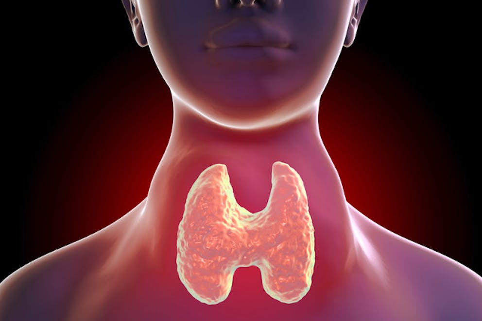 Enlarged thyroid iodine deficiency