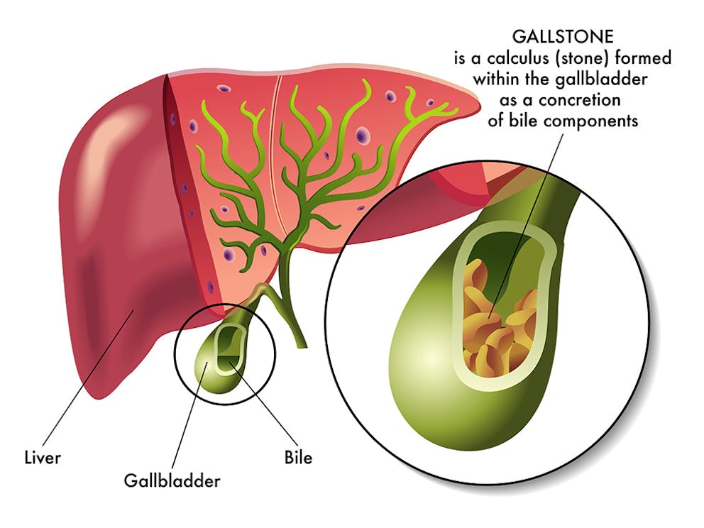 illustration of the gallbladder containing gallstones