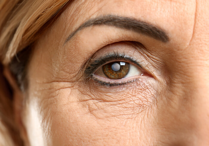 Woman with a cataract on the lens of her eye. |  Natural Remedies for Cataracts