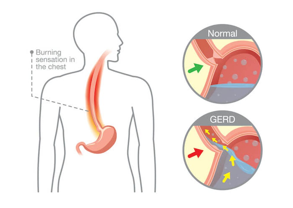 Diagram of the esophagus and acid reflux | Gastroesophageal Reflux Disease Treatment