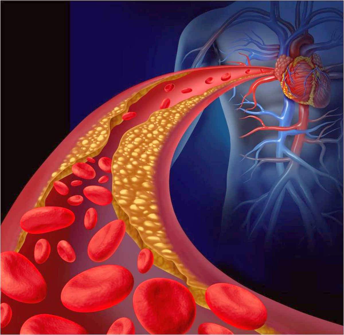 Clogged artery and atherosclerosis disease medical concept | How To Reverse Hardening Of The Arteries (Atherosclerosis) | what is atherosclerosis