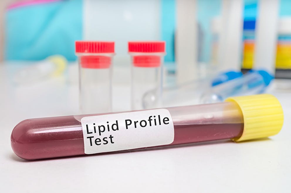 Test tube of blood labeled Lipid Profile Test, blood test.