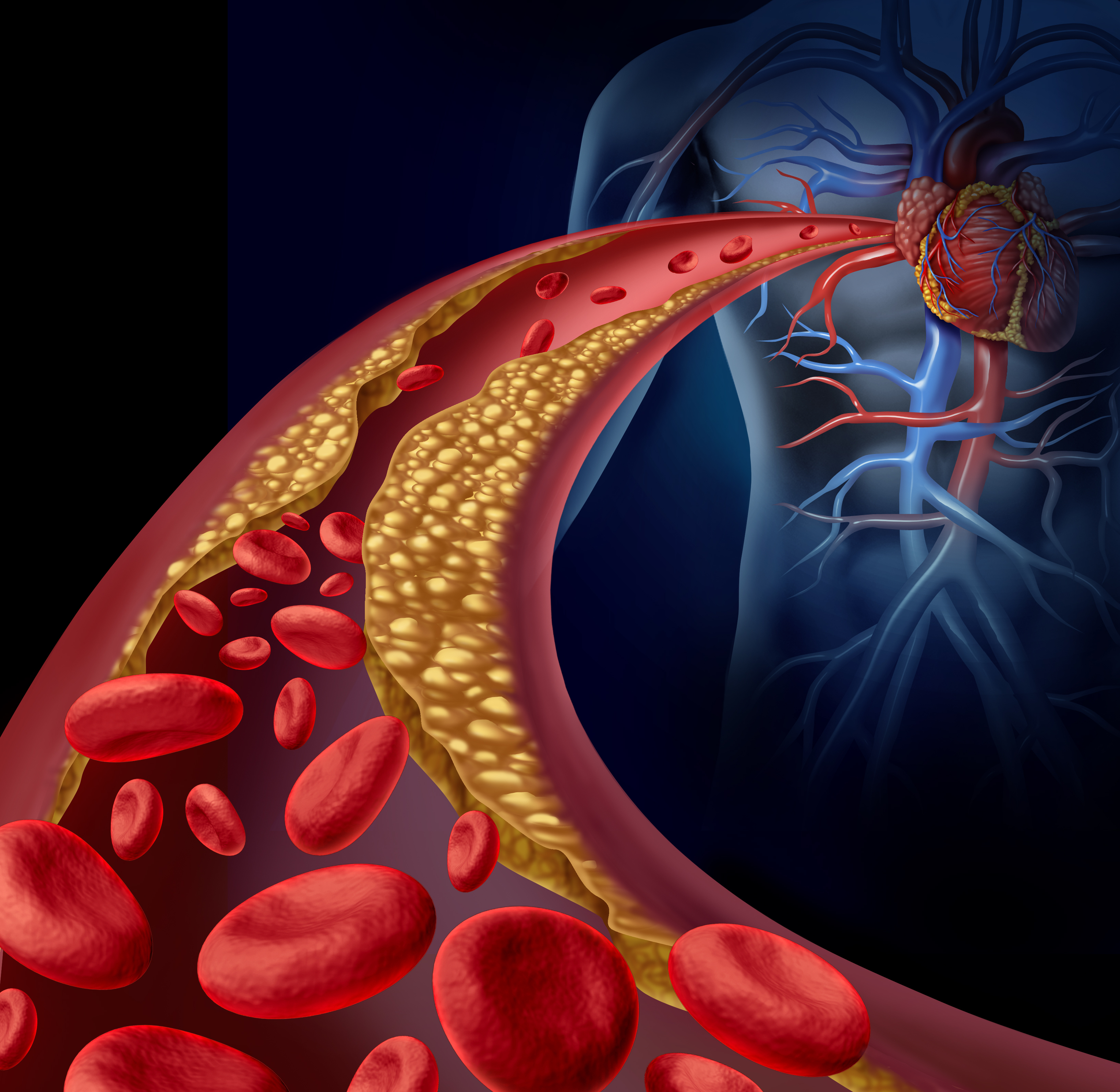 Plaque buildup in arteries