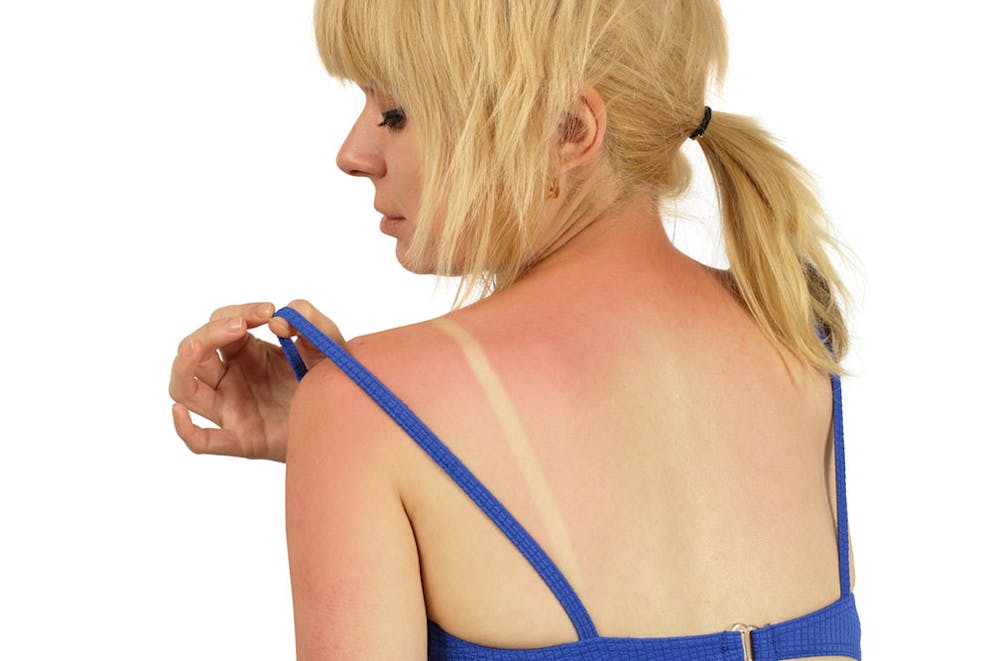 A blond woman lifts bra strap to show bad sunburn on back and shoulders, burn line red skin.