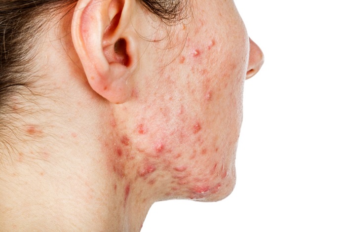 hormonal cystic acne