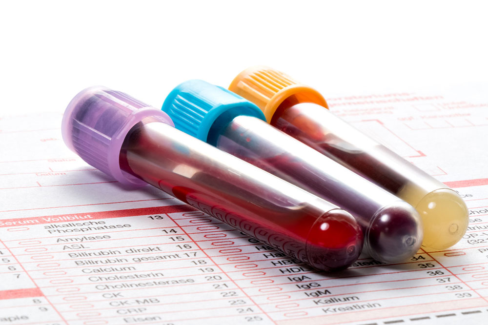 Three blood test vials filled with blood with different colored caps on a medical paper.