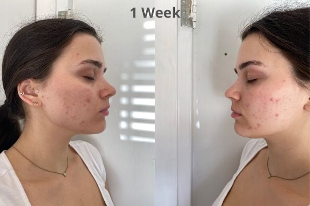 Acne after 1 week without dairy | The Hidden Source of Acne: Surprising