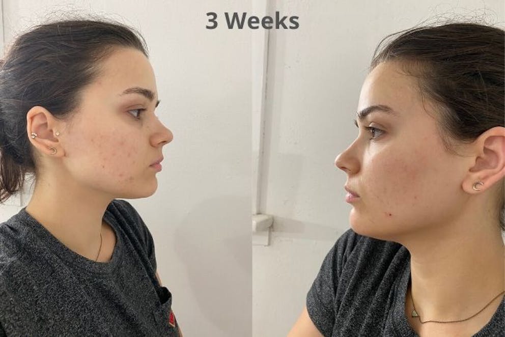 Acne after 3 weeks without dairy | The Hidden Source of Acne: Surprising