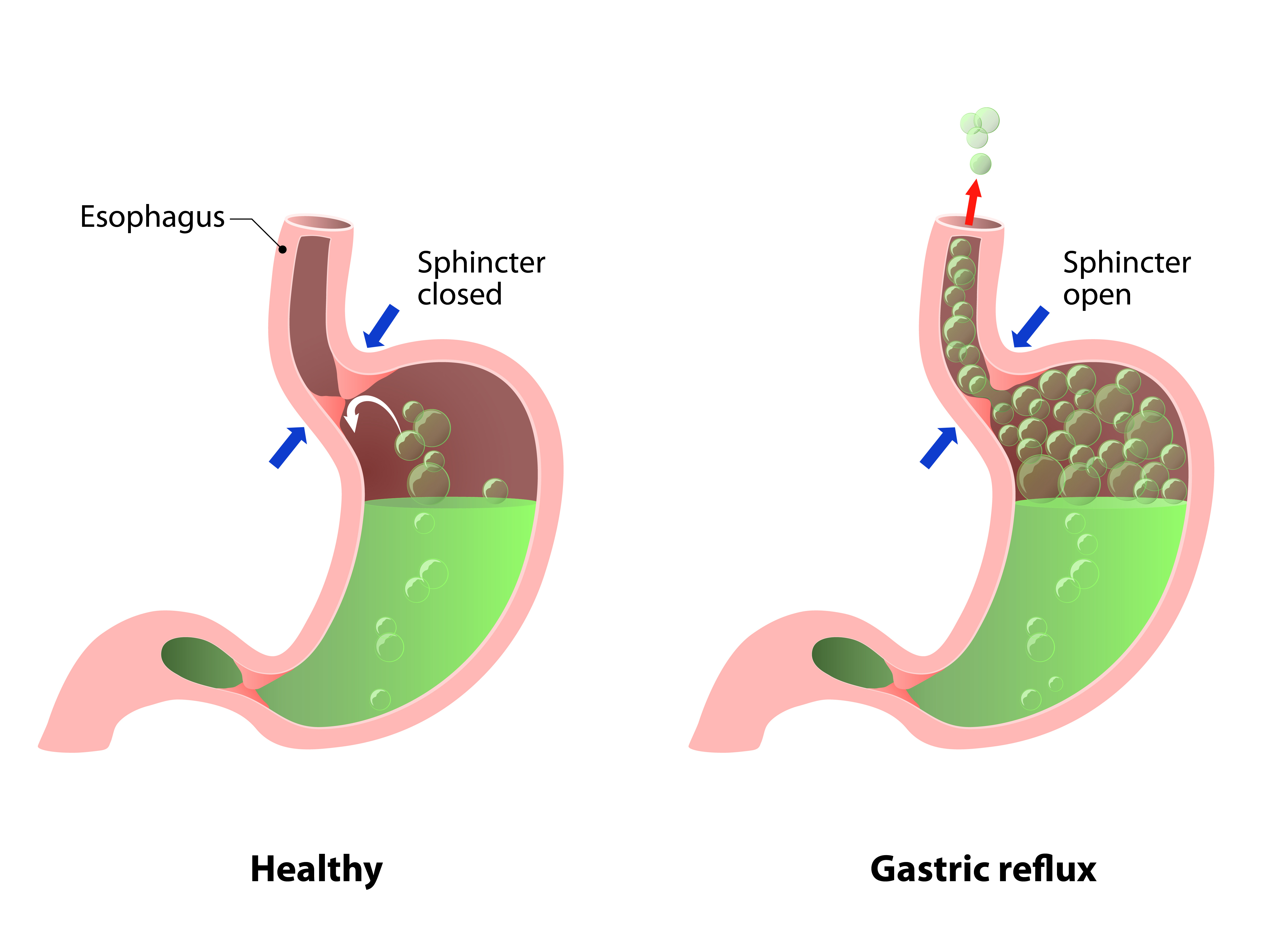 Gastric refulx