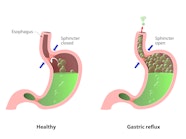 The Importance Of Hydrochloric Acid Dr Berg