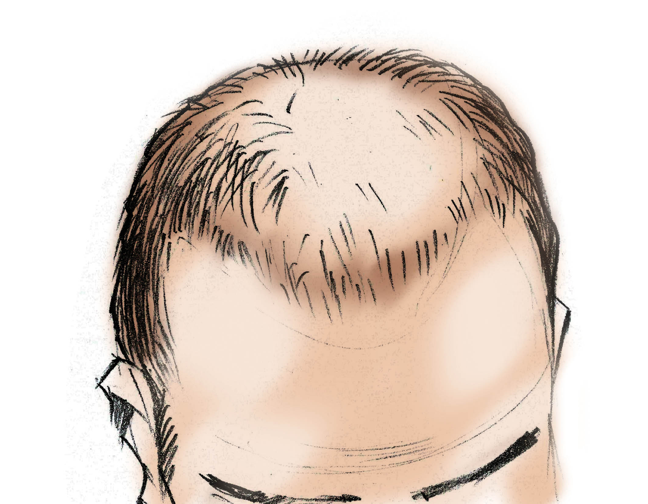 Balding