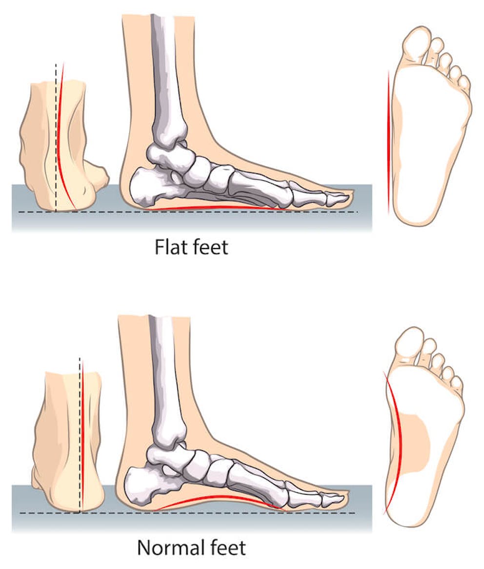 A comparison of flat feet and normal feet |  Best Flat Feet Exercises, Stretches, and More