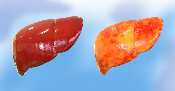 non-alcoholic fatty liver disease