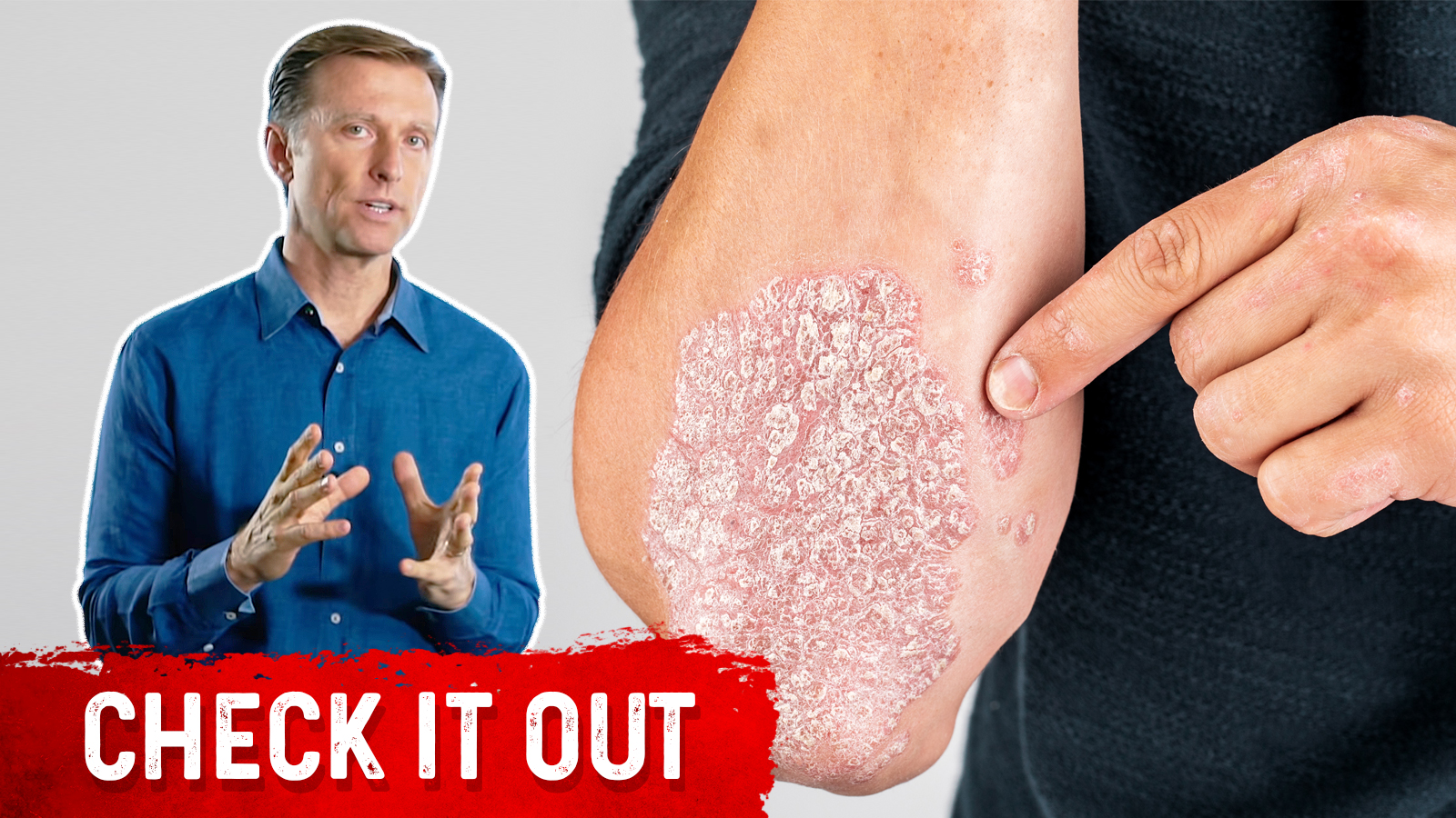 A Great Psoriasis Remedy | Healthy Keto™ Dr. Berg