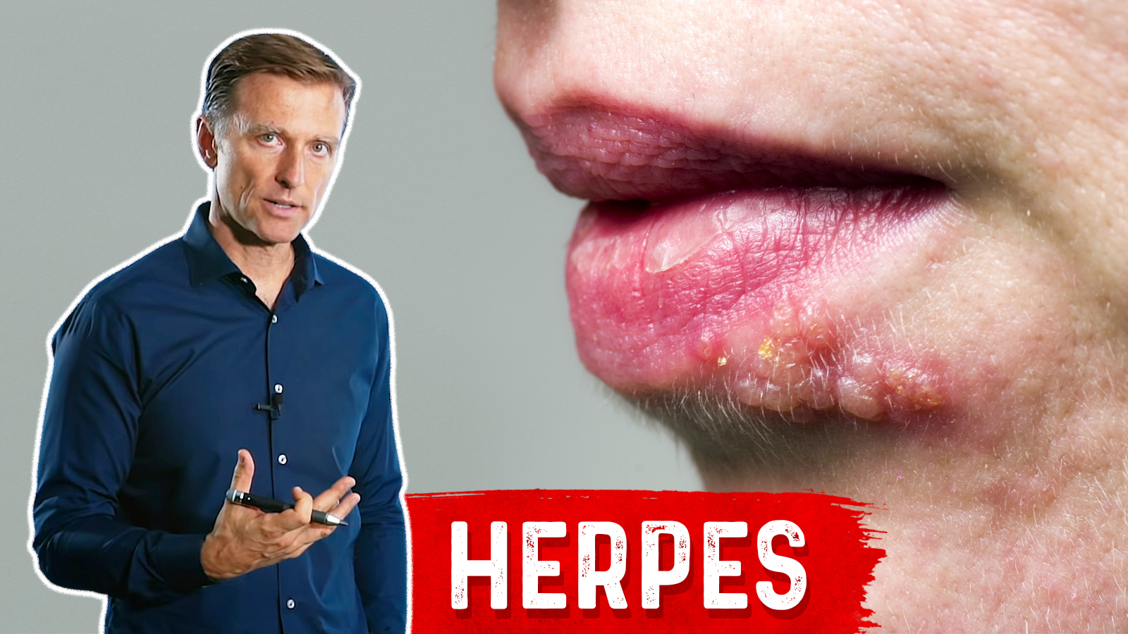 Best Foods to Eat and Avoid If You Have Herpes | Healthy Keto™ Dr. Berg