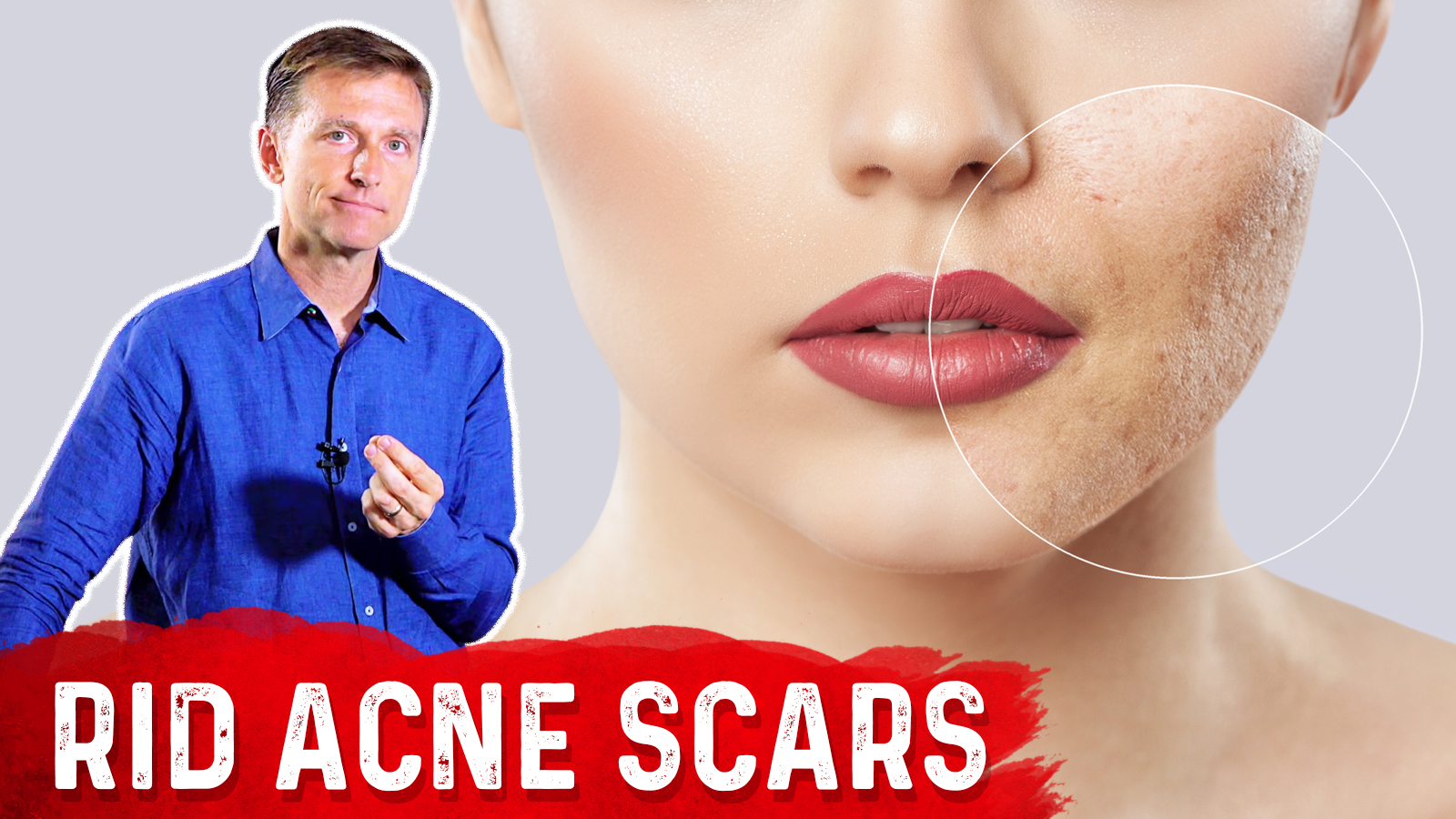 Best Way To Rid Acne Scars Healthy Keto™ Dr Berg